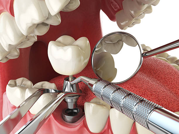 Best Emergency Wisdom Teeth Removal in Purdy, WA